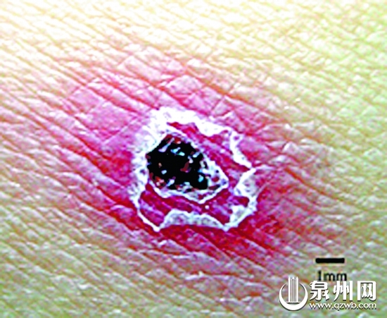 被恙蟲咬過會有黑色焦痂